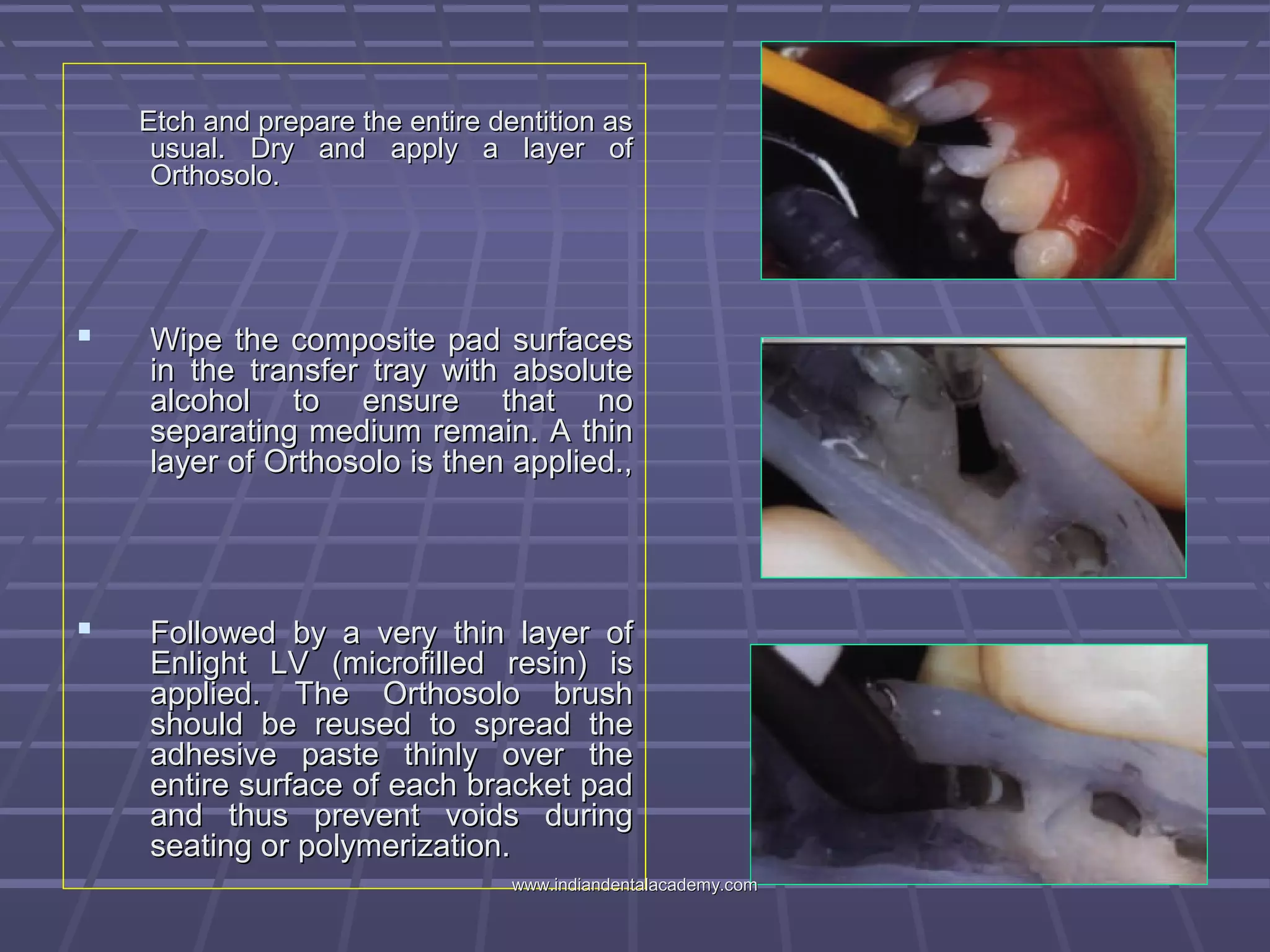 Etch and prepare the entire dentition asEtch and prepare the entire dentition as
usual. Dry and apply a layer ofusual. Dry and apply a layer of
Orthosolo.Orthosolo.
 Wipe the composite pad surfacesWipe the composite pad surfaces
in the transfer tray with absolutein the transfer tray with absolute
alcohol to ensure that noalcohol to ensure that no
separating medium remain. A thinseparating medium remain. A thin
layer of Orthosolo is then applied.,layer of Orthosolo is then applied.,
 Followed by a very thin layer ofFollowed by a very thin layer of
Enlight LV (microfilled resin) isEnlight LV (microfilled resin) is
applied. The Orthosolo brushapplied. The Orthosolo brush
should be reused to spread theshould be reused to spread the
adhesive paste thinly over theadhesive paste thinly over the
entire surface of each bracket padentire surface of each bracket pad
and thus prevent voids duringand thus prevent voids during
seating or polymerization.seating or polymerization.
www.indiandentalacademy.comwww.indiandentalacademy.com
 