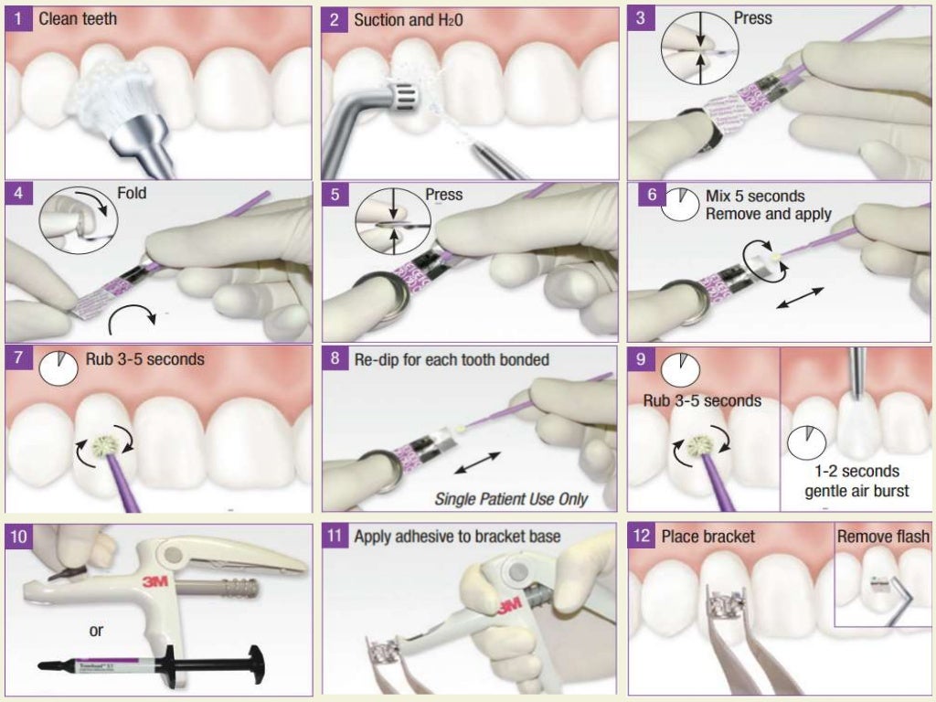 Bonding in orthodontics