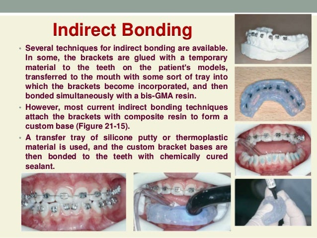 Bonding In Orthodontics