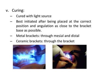 Bonding in orthodontics | PPTX