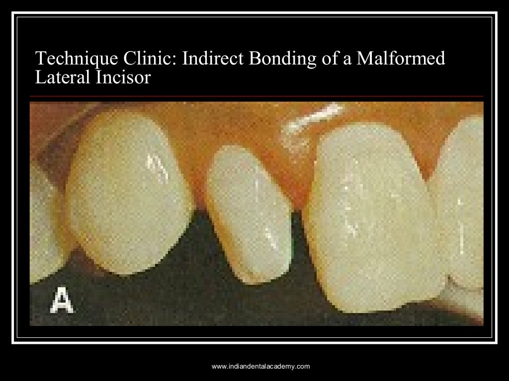 Bonding in orthodontics /certified fixed orthodontic courses by India…