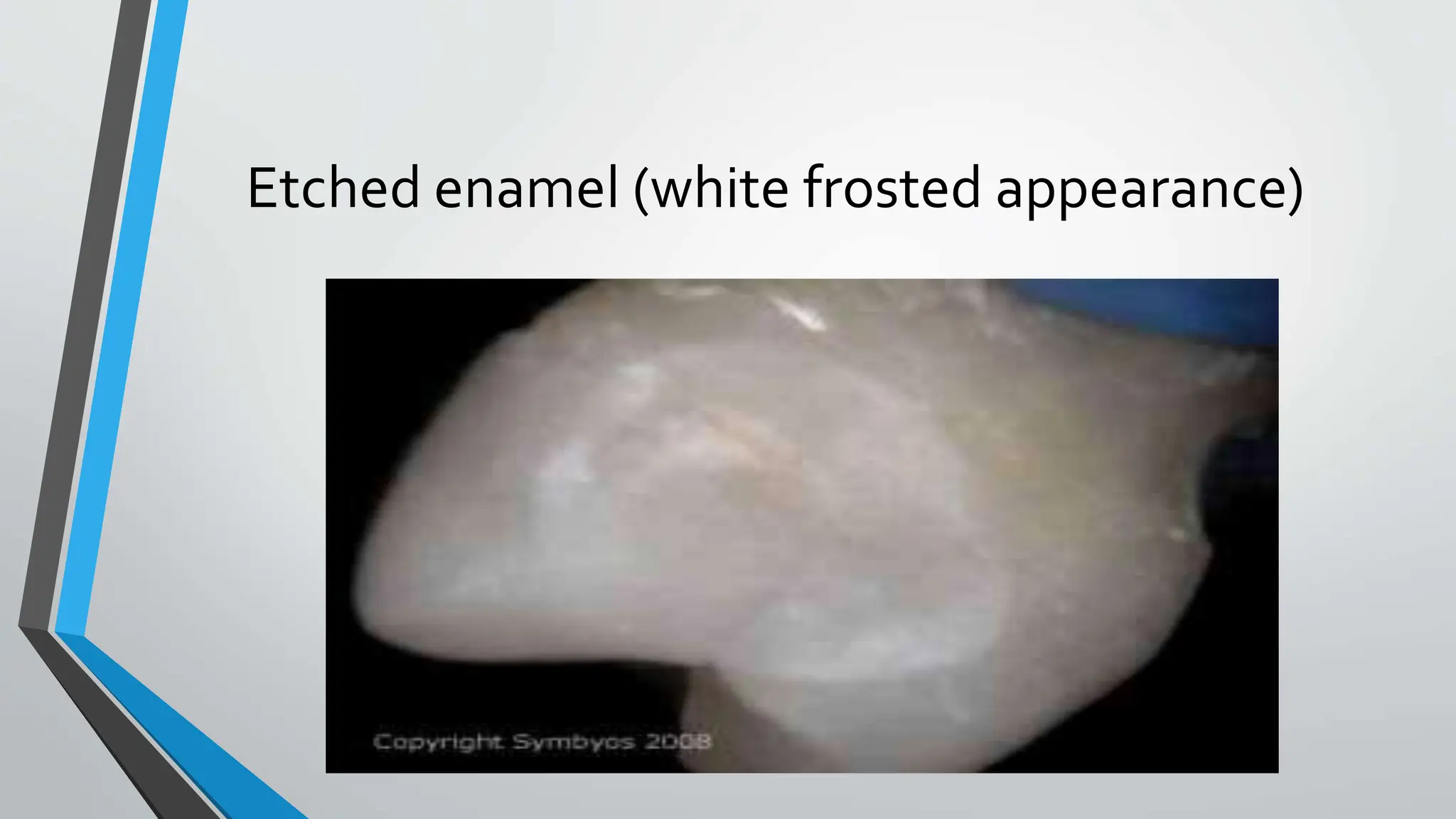 Etched enamel (white frosted appearance)
 