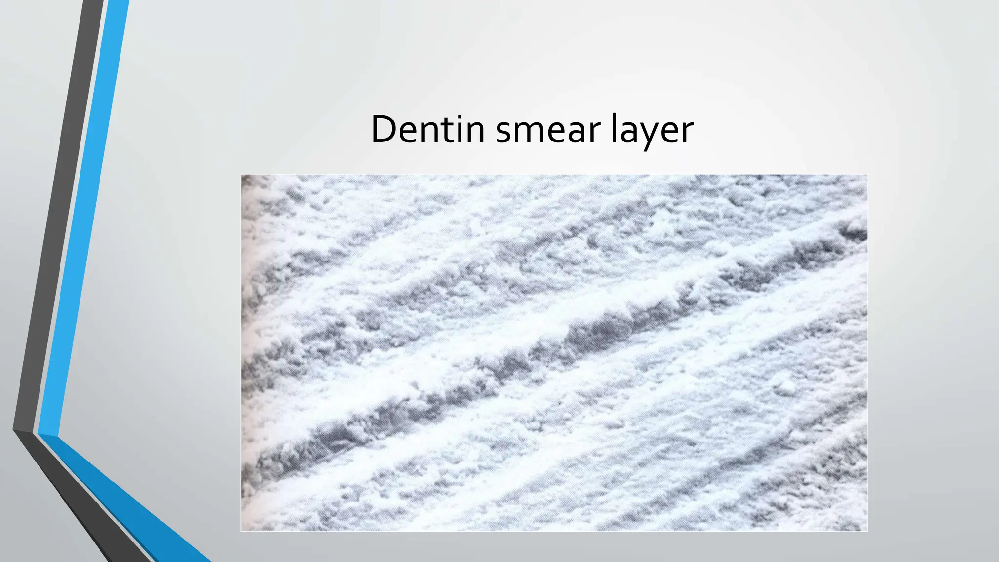 Dentin smear layer
 