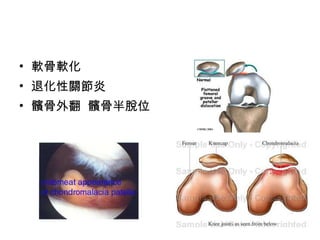 軟骨軟化 退化性關節炎 髕骨外翻  髕骨半脫位  