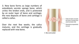 3. New bone forms as large numbers of
osteoblasts secrete spongy bone, which
unites the broken ends, and is protected
by an outer layer of bone and cartilage;
the new deposits of bone and cartilage is
called a callus.
Over the next few weeks, the callus
matures, and the cartilage is gradually
replaced with new bone.
 