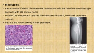• Microscopic:
- tumor consists of sheets of uniform oval mononuclear cells and numerous osteoclast-type
giant cells with 100 or more nuclei
- nuclei of the mononuclear cells and the osteoclasts are similar, ovoid with prominent
nucleoli.
• Necrosis and mitotic activity may be prominent.
Giant cell tumor of the
proximal fibula is
predominantly lytic, expansile
with destruction of the cortex.
A pathologic fracture is also
present.
Benign giant cell tumor illustrating an abundance
of multinucleated giant cells with background
mononuclear stromal cells.
 