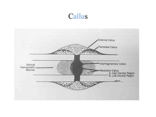 Bone Callouses BONE-TYPES,CLASSIFICATION,HISTOLOGY,FRACTURE, | PPT