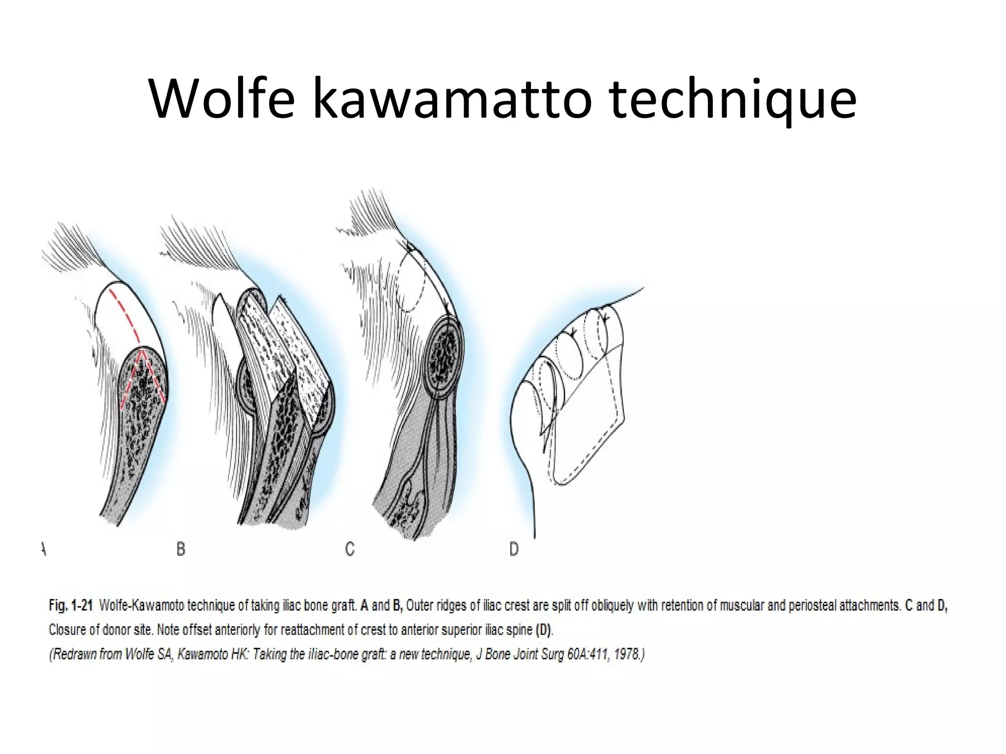 Wolfe kawamatto technique 
 