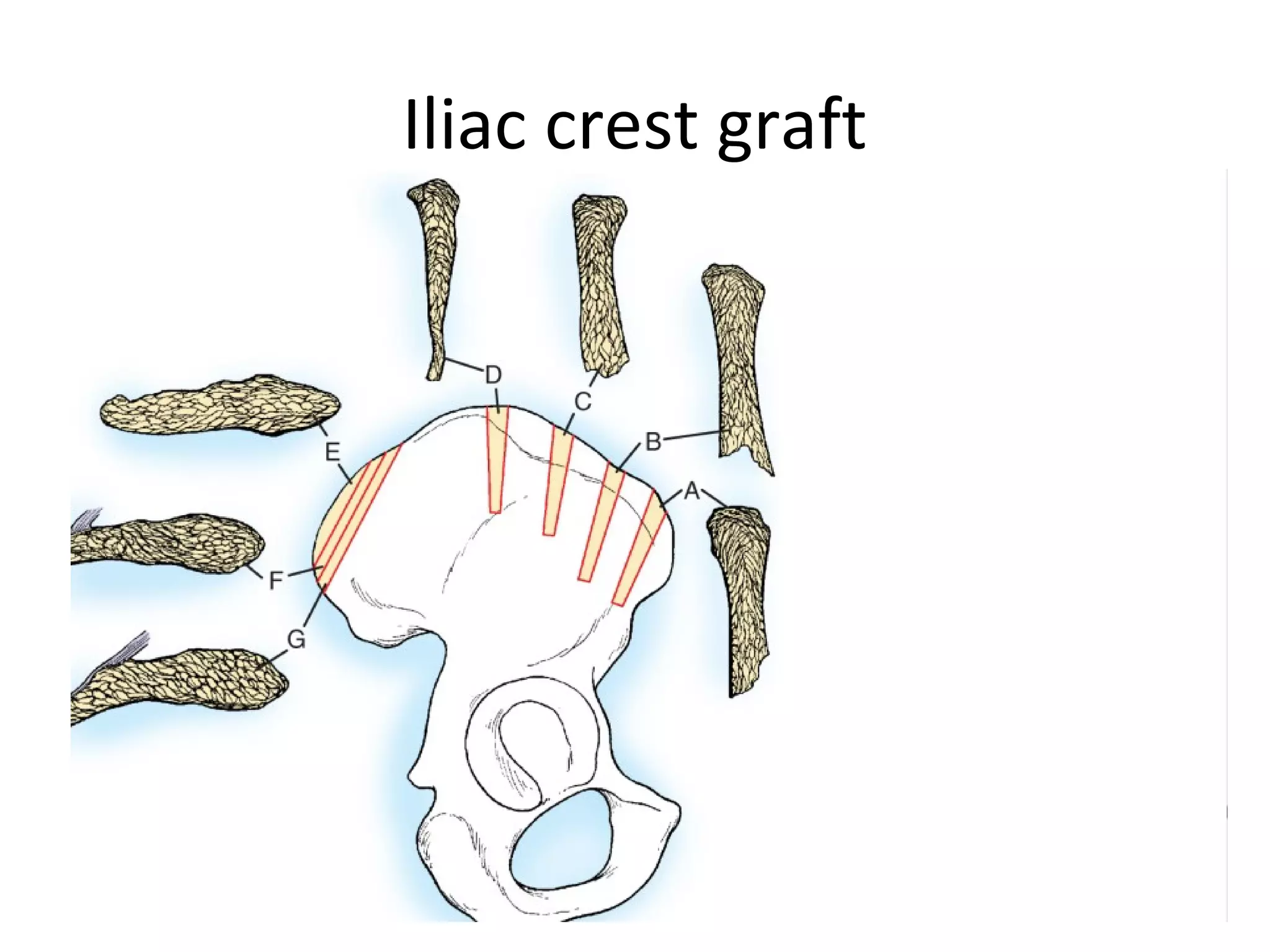 Iliac crest graft 
 