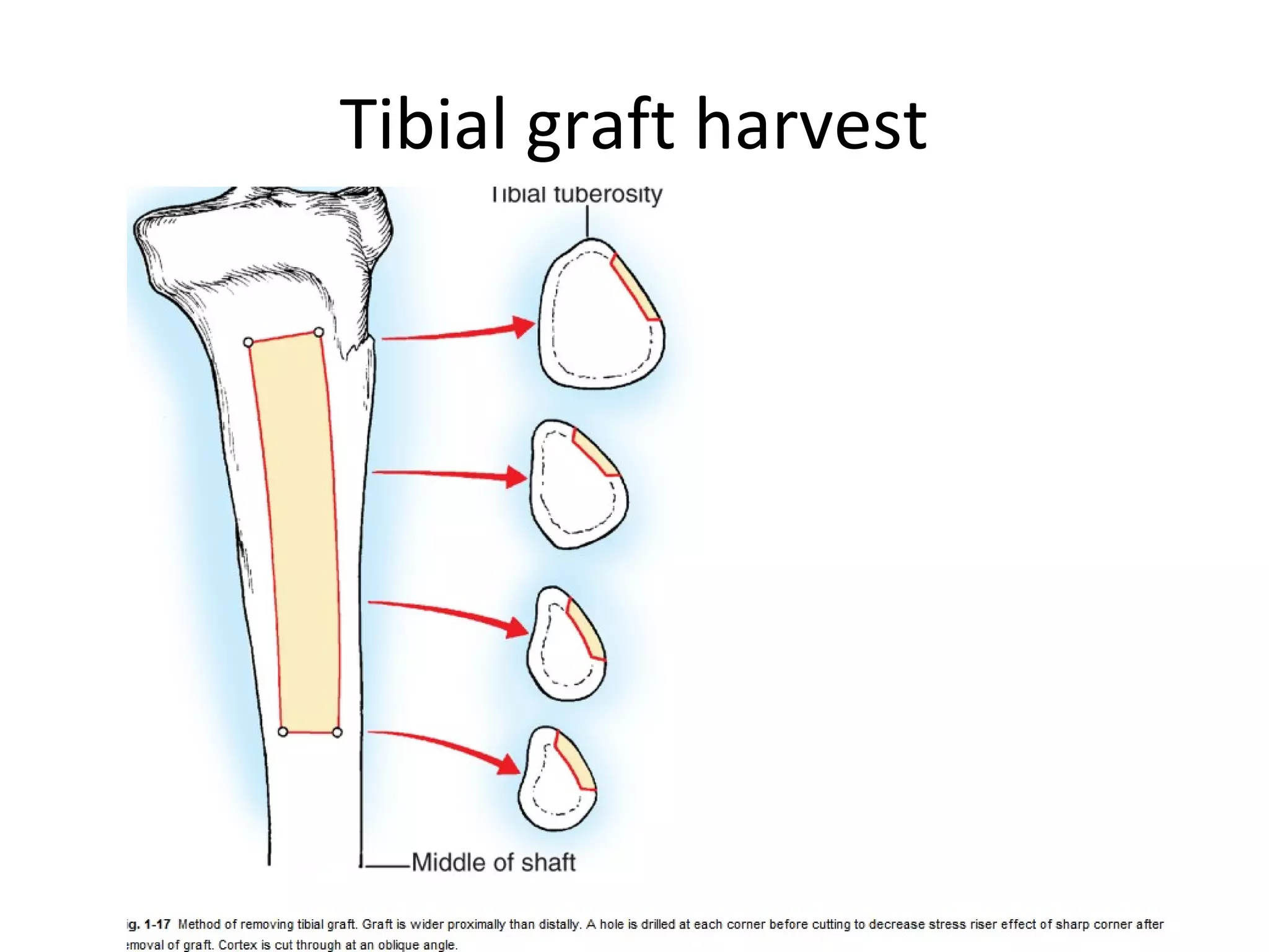 Tibial graft harvest 
 
