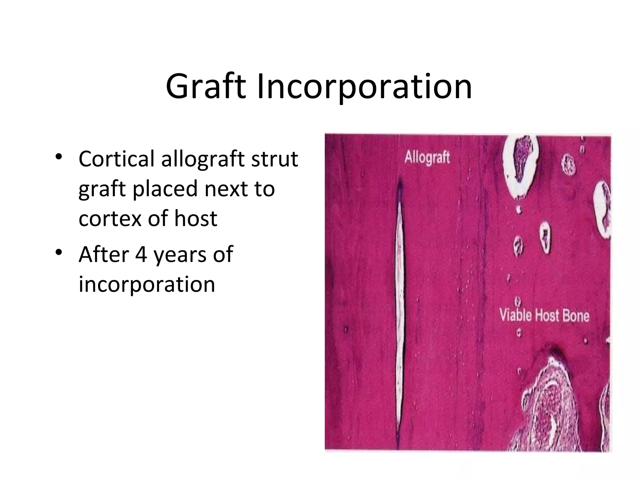 Graft Incorporation 
• Cortical allograft strut 
graft placed next to 
cortex of host 
• After 4 years of 
incorporation 
 