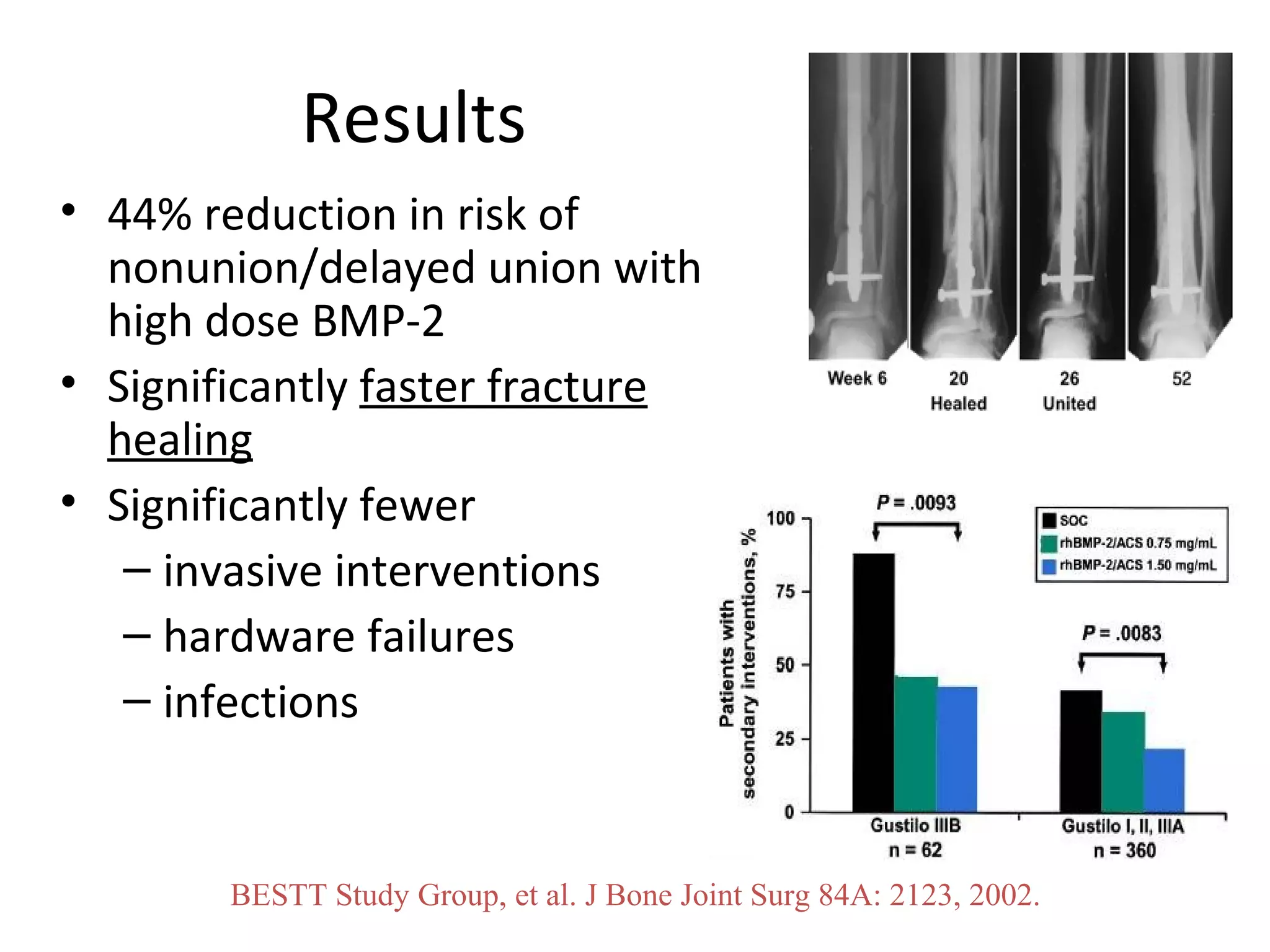 Results 
• 44% reduction in risk of 
nonunion/delayed union with 
high dose BMP-2 
• Significantly faster fracture 
healing 
• Significantly fewer 
– invasive interventions 
– hardware failures 
– infections 
BESTT Study Group, et al. J Bone Joint Surg 84A: 2123, 2002. 
 