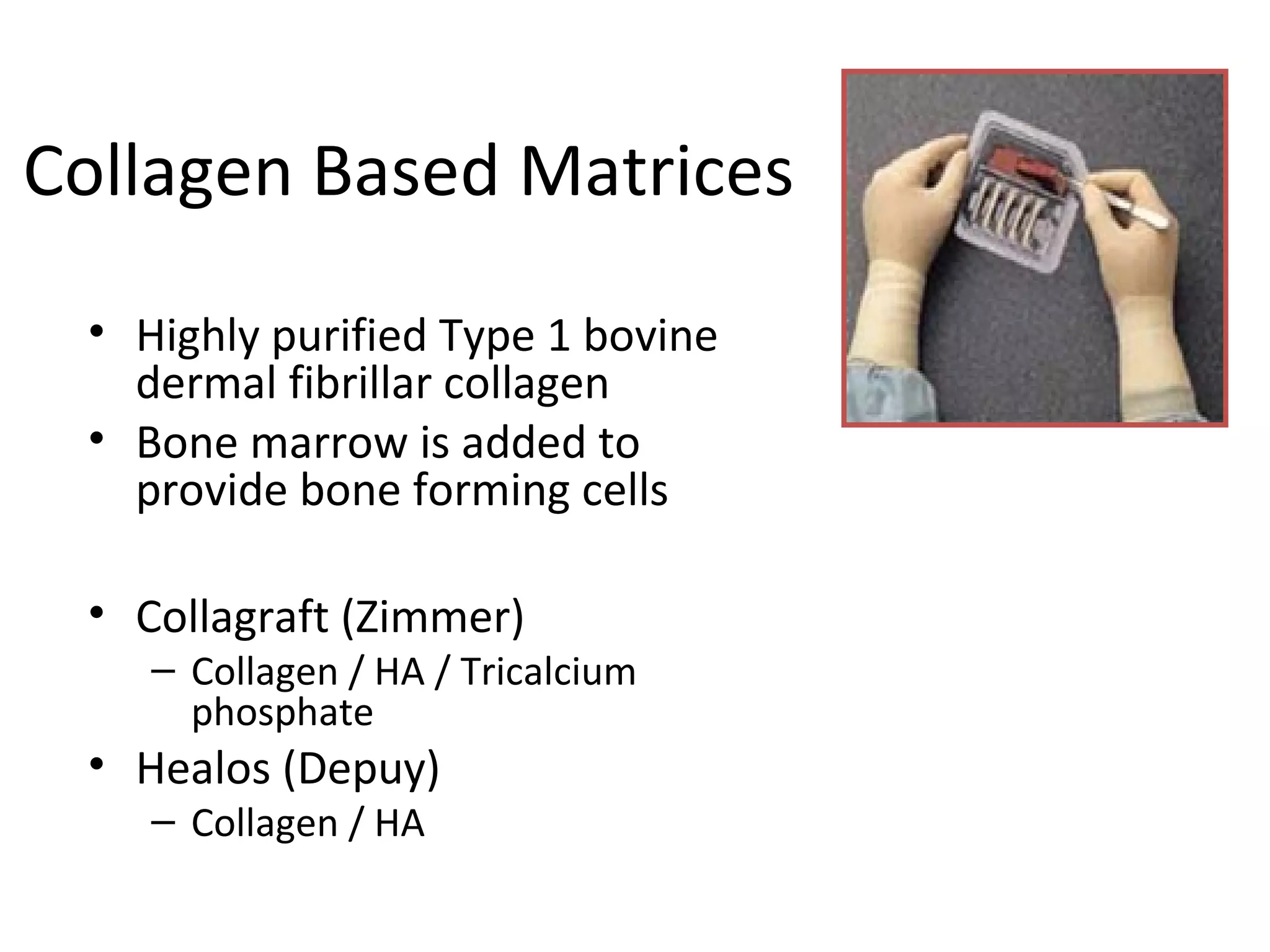 Collagen Based Matrices 
• Highly purified Type 1 bovine 
dermal fibrillar collagen 
• Bone marrow is added to 
provide bone forming cells 
• Collagraft (Zimmer) 
– Collagen / HA / Tricalcium 
phosphate 
• Healos (Depuy) 
– Collagen / HA 
 