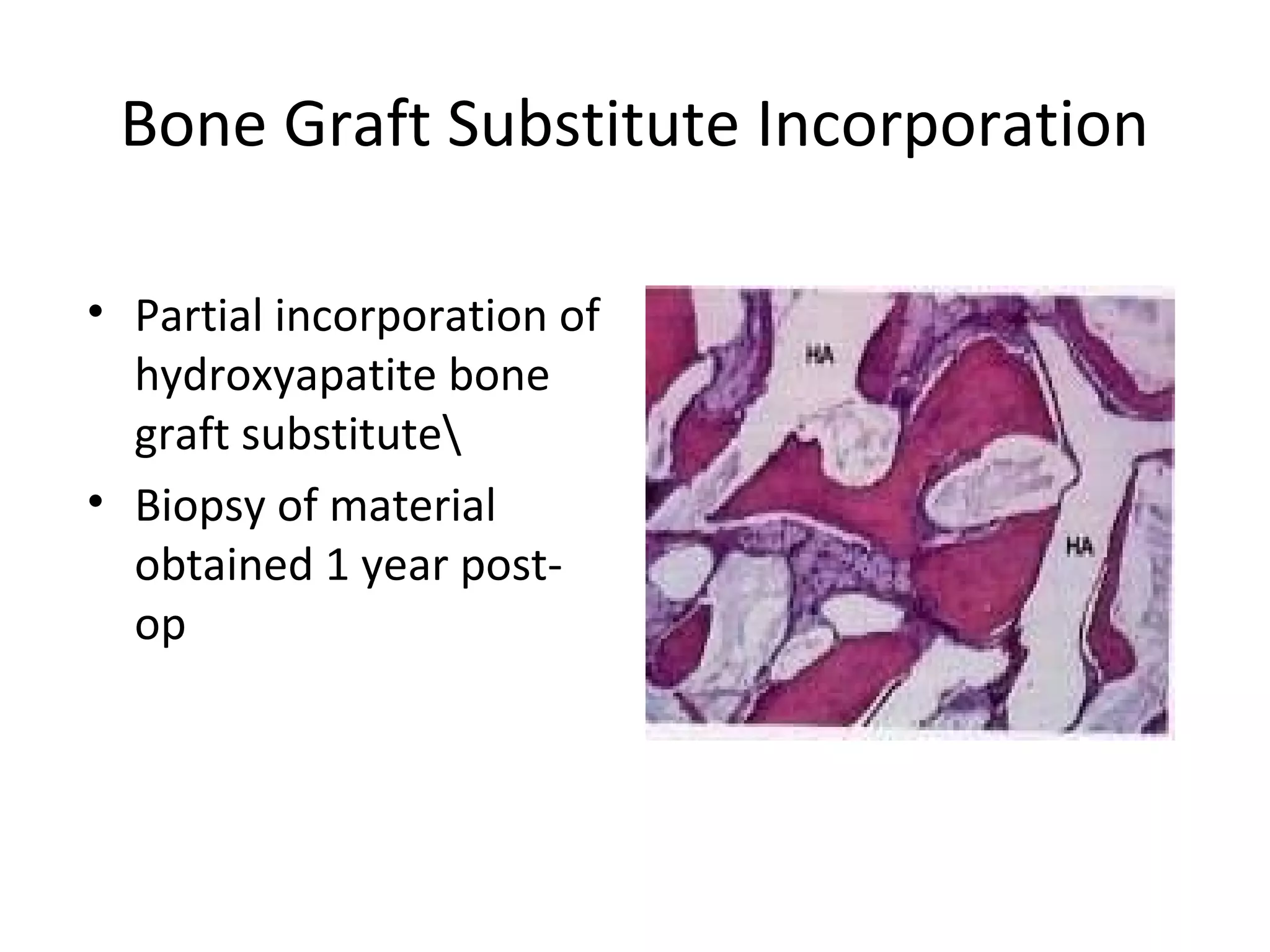 Bone Graft Substitute Incorporation 
• Partial incorporation of 
hydroxyapatite bone 
graft substitute 
• Biopsy of material 
obtained 1 year post-op 

