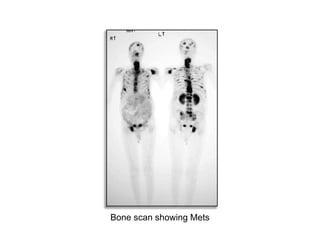 Bone scan showing Mets 