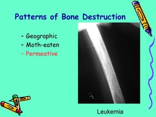 Patterns of Bone Destruction
– Geographic
– Moth-eaten
– Permeative
Leukemia
 