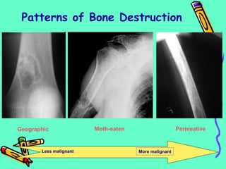 Patterns of Bone Destruction
Geographic Moth-eaten Permeative
Less malignant More malignant
 