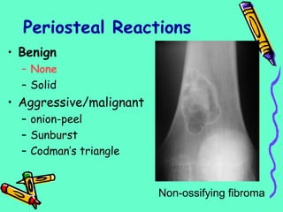 Periosteal Reactions
• Benign
– None
– Solid
• Aggressive/malignant
– onion-peel
– Sunburst
– Codman’s triangle
Non-ossifying fibroma
 
