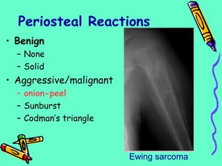 Periosteal Reactions
• Benign
– None
– Solid
• Aggressive/malignant
– onion-peel
– Sunburst
– Codman’s triangle
Ewing sarcoma
 