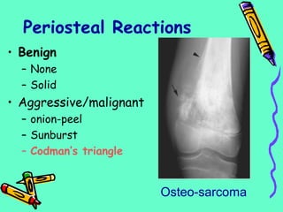 Periosteal Reactions
• Benign
– None
– Solid
• Aggressive/malignant
– onion-peel
– Sunburst
– Codman’s triangle
Osteo-sarcoma
 