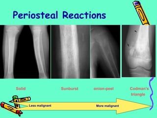 Periosteal Reactions
Solid onion-peelSunburst Codman’s
triangle
Less malignant More malignant
 