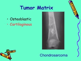 • Osteoblastic
• Cartilaginous
Tumor Matrix
Chondrosarcoma
 