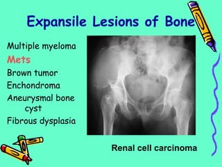 Multiple myeloma
Mets
Brown tumor
Enchondroma
Aneurysmal bone
cyst
Fibrous dysplasia
Expansile Lesions of Bone
Renal cell carcinoma
 