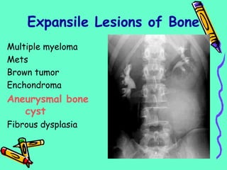 Multiple myeloma
Mets
Brown tumor
Enchondroma
Aneurysmal bone
cyst
Fibrous dysplasia
Expansile Lesions of Bone
 