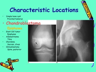 Characteristic Locations
• Simple bone cyst
Proximal humerus
• Chondroblastoma
Epiphyses
• Giant Cell tumor
Epiphyses
• Adamantinoma
Tibia
• Chordoma
Sacrum, clivus
• Osteoblastoma
Spine, posterior
 