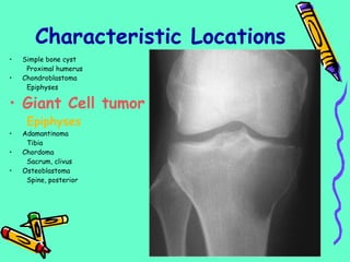 • Simple bone cyst
Proximal humerus
• Chondroblastoma
Epiphyses
• Giant Cell tumor
Epiphyses
• Adamantinoma
Tibia
• Chordoma
Sacrum, clivus
• Osteoblastoma
Spine, posterior
Characteristic Locations
 