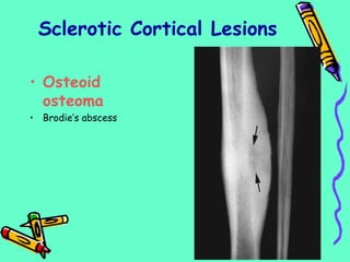 Sclerotic Cortical Lesions
• Osteoid
osteoma
• Brodie’s abscess
 