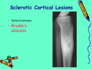 • Osteoid osteoma
• Brodie’s
abscess
Sclerotic Cortical Lesions
 