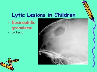 Lytic Lesions in Children
• Eosinophilic
granuloma
• Leukemia
 