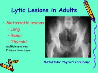Lytic Lesions in Adults
• Metastatic lesions
– Lung
– Renal
– Thyroid
• Multiple myeloma
• Primary bone tumor
Metastatic thyroid carcinoma
 