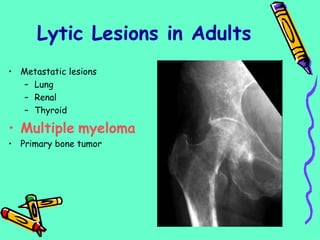 • Metastatic lesions
– Lung
– Renal
– Thyroid
• Multiple myeloma
• Primary bone tumor
Lytic Lesions in Adults
 