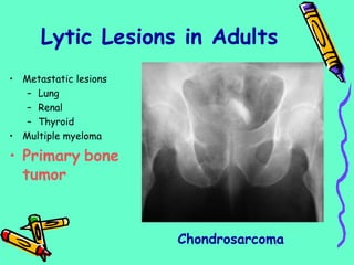 • Metastatic lesions
– Lung
– Renal
– Thyroid
• Multiple myeloma
• Primary bone
tumor
Chondrosarcoma
Lytic Lesions in Adults
 