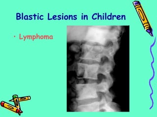 • Lymphoma
Blastic Lesions in Children
 