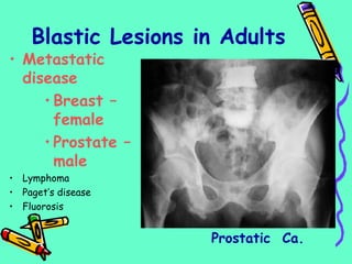 • Metastatic
disease
• Breast –
female
• Prostate –
male
• Lymphoma
• Paget’s disease
• Fluorosis
Prostatic Ca.
Blastic Lesions in Adults
 