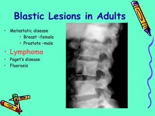 • Metastatic disease
• Breast –female
• Prostate –male
• Lymphoma
• Paget’s disease
• Fluorosis
Blastic Lesions in Adults
 