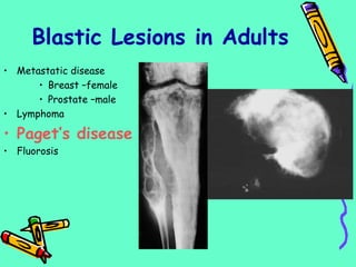 • Metastatic disease
• Breast –female
• Prostate –male
• Lymphoma
• Paget’s disease
• Fluorosis
Blastic Lesions in Adults
 