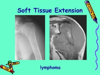 lymphoma
Soft Tissue Extension
 