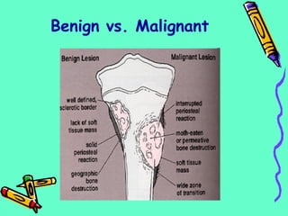Benign vs. Malignant
 