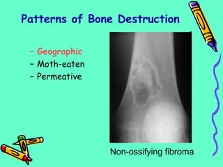 Patterns of Bone Destruction
– Geographic
– Moth-eaten
– Permeative
Non-ossifying fibroma
 