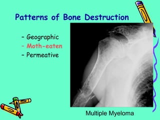 Patterns of Bone Destruction
– Geographic
– Moth-eaten
– Permeative
Multiple Myeloma
 