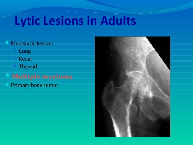 Bone tumors muhammad 1