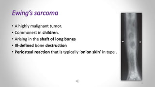 Ewing’s sarcoma
• A highly malignant tumor.
• Commonest in children.
• Arising in the shaft of long bones
• Ill-defined bone destruction
• Periosteal reaction that is typically ‘onion skin’ in type .
10
 