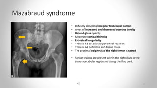 Mazabraud syndrome
• Diffusely abnormal irregular trabecular pattern
• Areas of increased and decreased osseous density
• Ground-glass opacity
• Moderate cortical thinning
• Endosteal irregularity
• There is no associated periosteal reaction
• There is no definitive soft-tissue mass.
• The proximal epiphysis of the right femur is spared
• Similar lesions are present within the right ilium in the
supra-acetabular region and along the iliac crest.
17
 