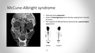 McCune-Albright syndrome
• Extensive bony expansion
• Areas of heterogeneous bone density ranging from sclerotic
to lucent.
• The majority of affected bones demonstrate a ground-glass
appearance.
18
 