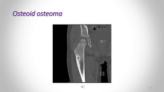 Osteoid osteoma
23
 