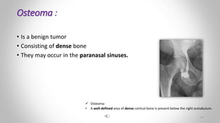Osteoma :
• Is a benign tumor
• Consisting of dense bone
• They may occur in the paranasal sinuses.
 Osteoma:
• A well-defined area of dense cortical bone is present below the right acetabulum.
24
 